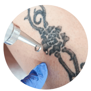 Picolaser voor verschillende huidproblemen