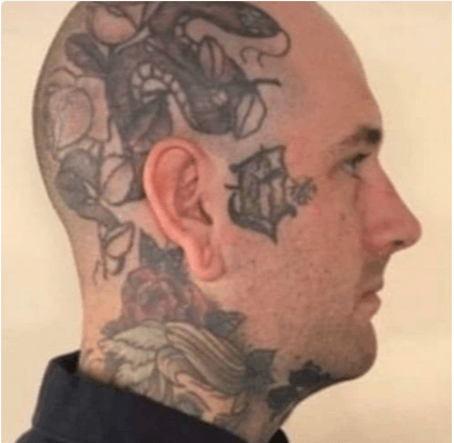Pico laser tattoo verwijderen op hoofd - Voor