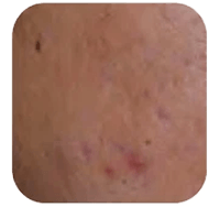 PIco laser behandeling voor hardnekkige acne litekens