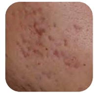 Pico laser behandeling voor hardnekkige acne litekens