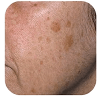 Pigment vlekken verwijderen pico laser