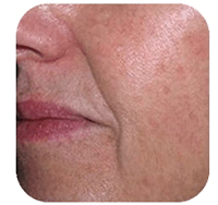 Pigment vlekken verwijderen met pico laser