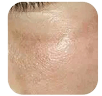 Met pico laser pigmentatie verminderen