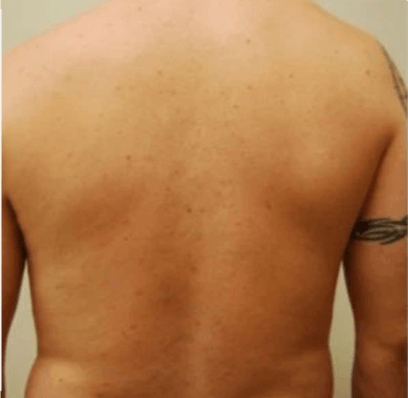 na een tattoo verwijderen op de rug - pico laser