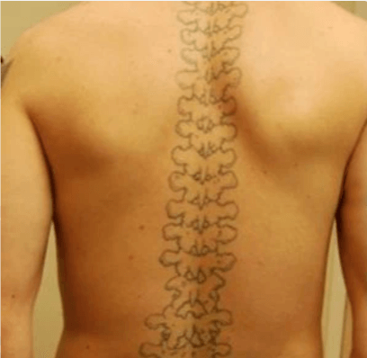 Voor tattoo verwijderen