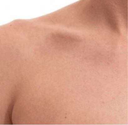 Na een pico laser behandeling, tattoo verwijderen