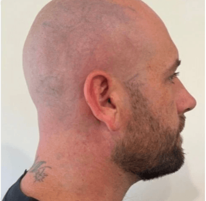 Tattoo verwijderen op hoofd na pico laser